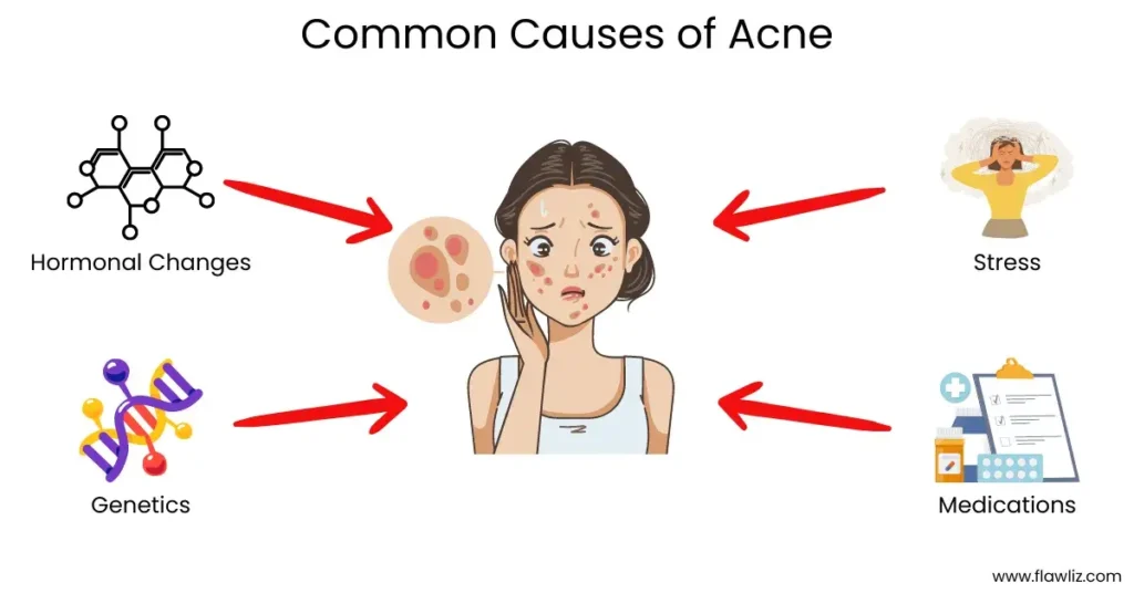 Illustration of common causes of acne