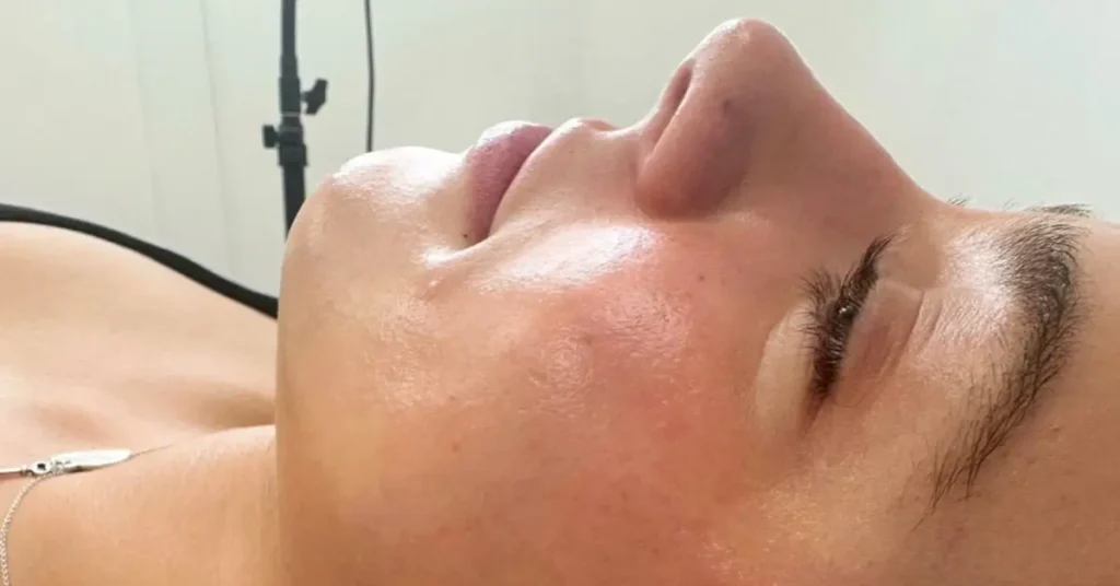 Womans face after dermaplaning session