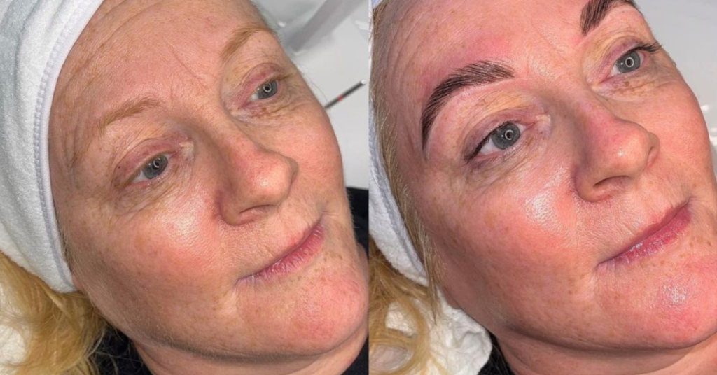 blonde woman before and after dermaplaning treatment