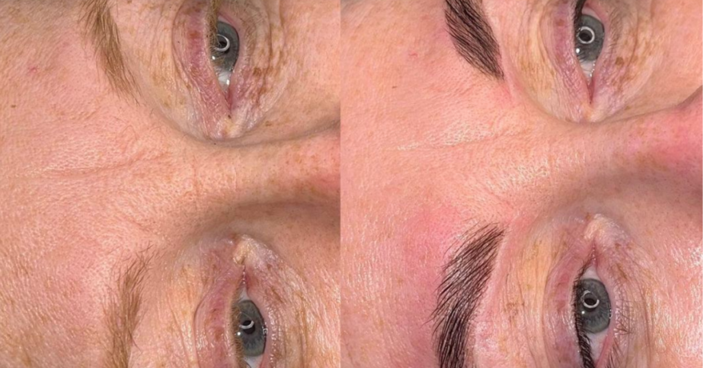 old woman dermaplaning before and after