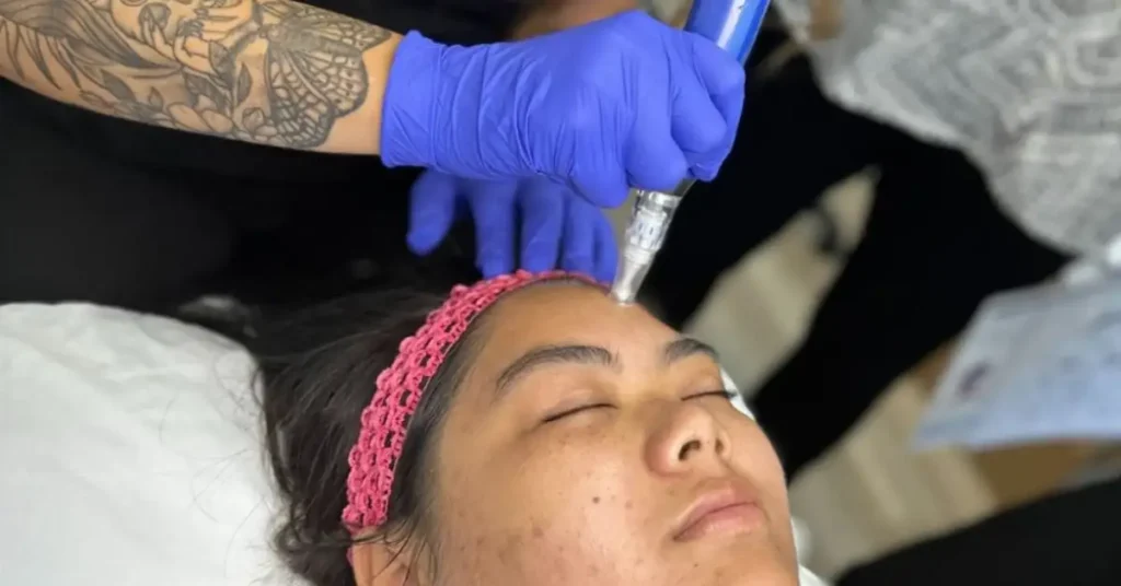 woman with blue gloves doing microneedling treatment
