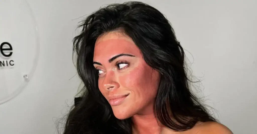 black haired woman after microneedling treatment