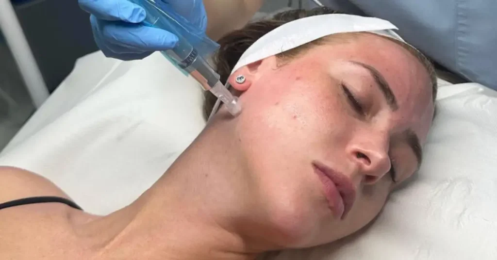 microneedling treatment on young woman
