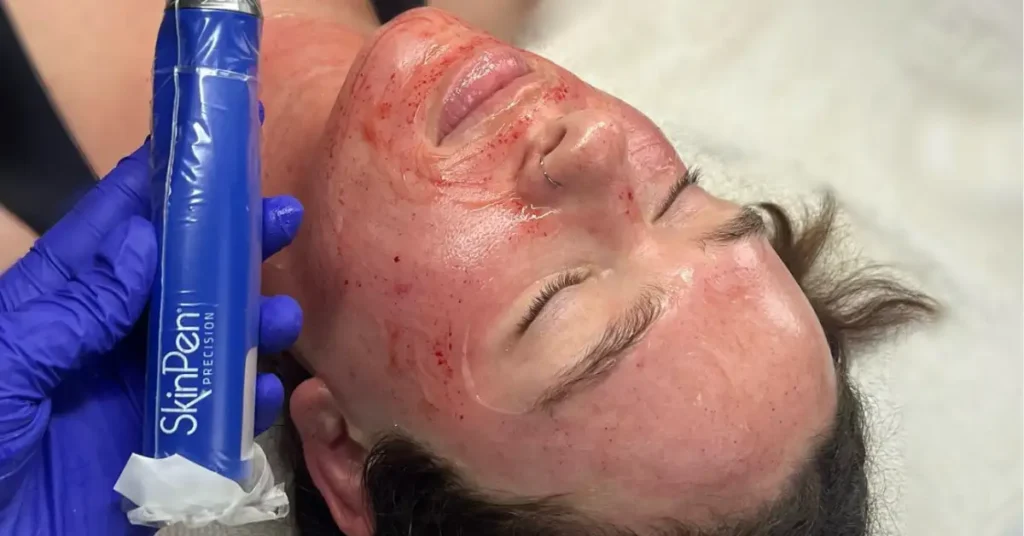 woman after microneedling session with skin pen