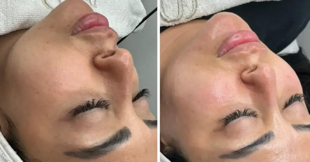 young black haired woman before and after dermaplaning