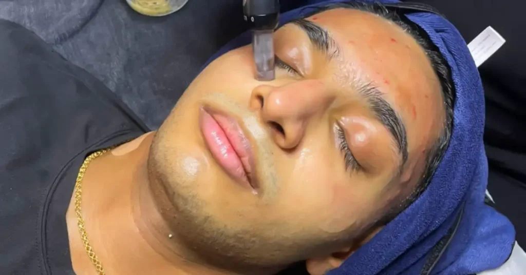 young indian man getting microneedling treatment