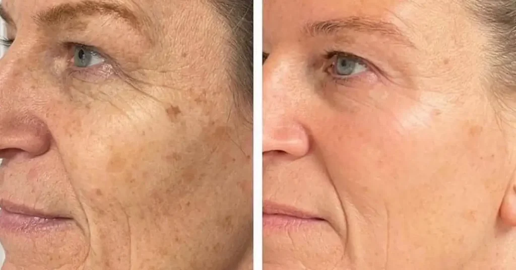 old womans face before and after microneedling