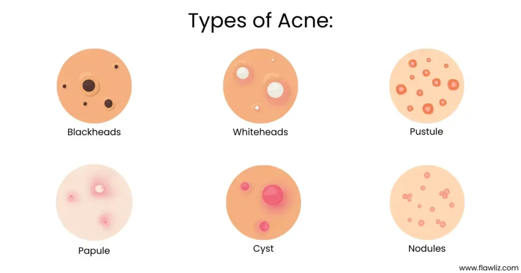 types of acne