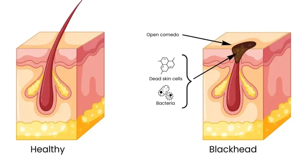 Does Niacinamide Help With Blackheads