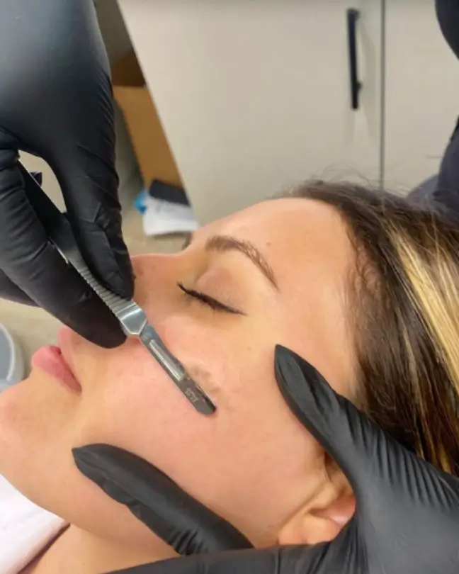 young woman getting dermaplaning treatment
