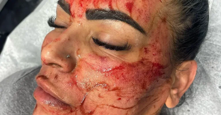 woman with bloody face after microneedling treatment