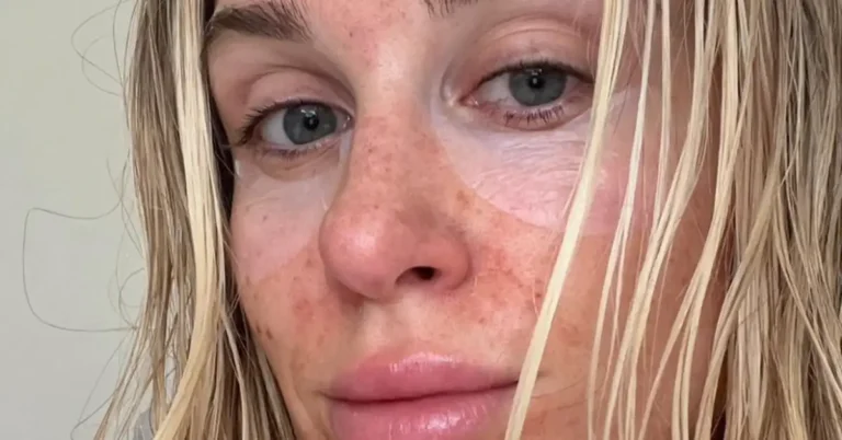 young blonde woman after microneedling treatment