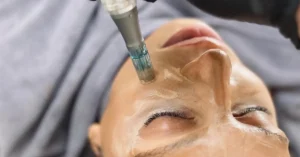 young woman getting microneedling treatment on her left cheek