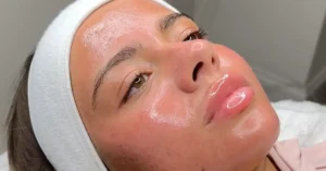 young womans face after microneedling treatment