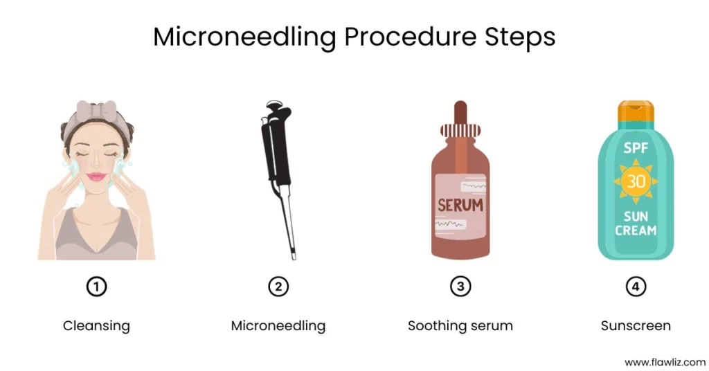 Illustration of Microneedling Procedure Steps
